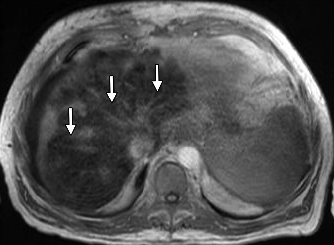 Medical MRI scan showing early signs of fatty liver infiltration with white arrows pointing to affected areas